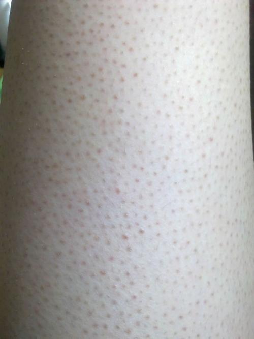 皮肤有鸡皮疙瘩怎么治,皮肤有鸡皮疙瘩吃什么好