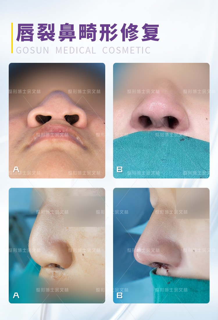 鼻子畸形堵住了怎么治？唇裂继发鼻畸形的患者可以这样做
