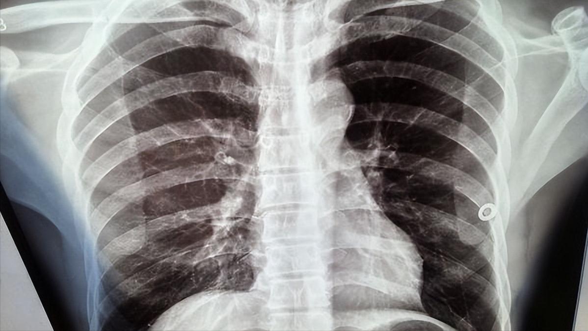 胸痛失眠盗汗是怎么回事,胸膜炎盗汗的症状