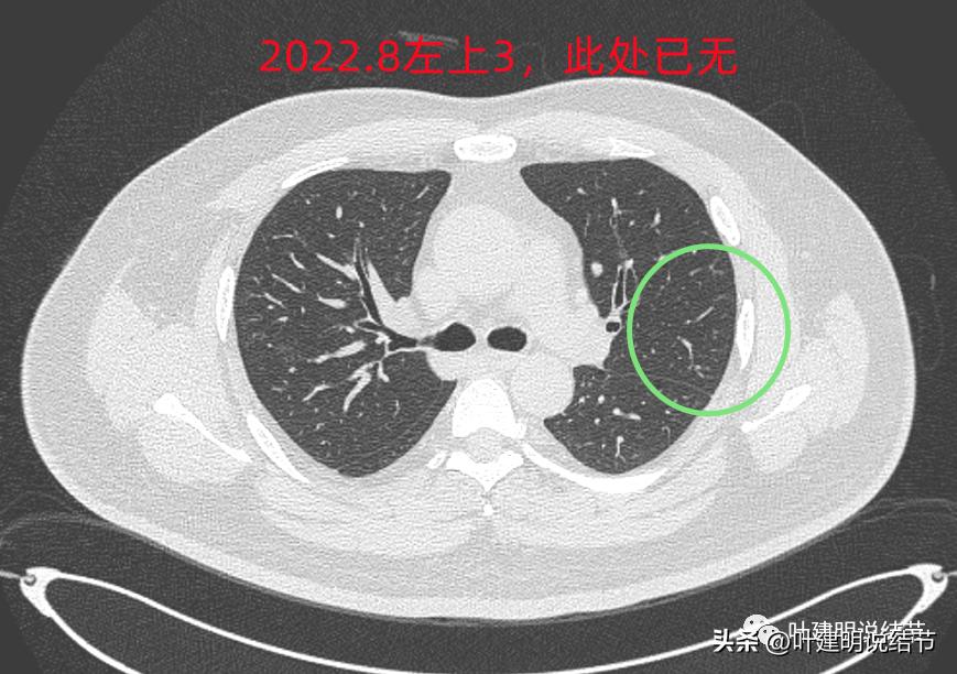 如何判断肺磨玻璃结节是高危结节,肺上有混合磨玻璃结节要注意什么