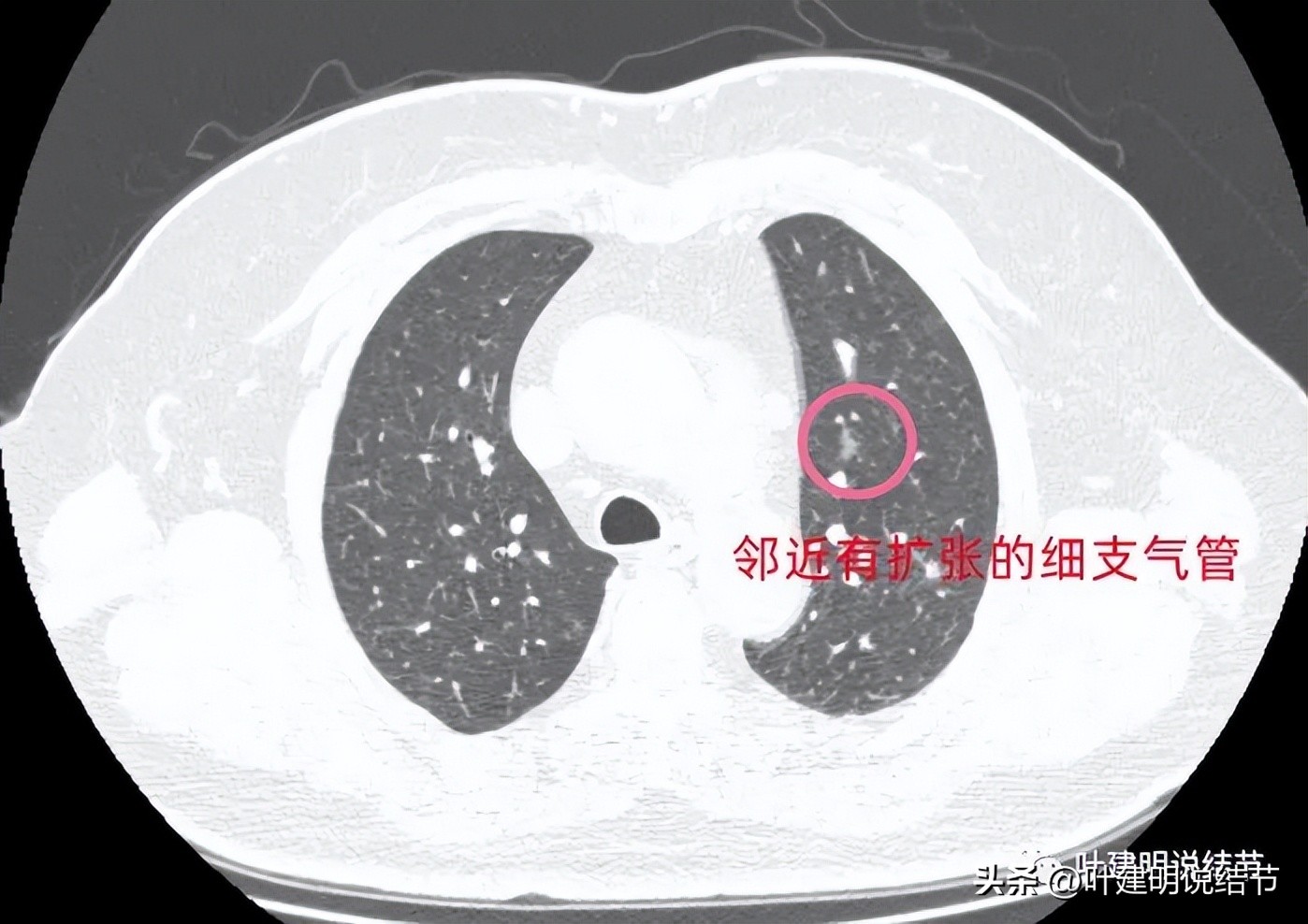 肺结节实性为什么建议抗炎治疗,肺上实性结节抗炎后变成空洞
