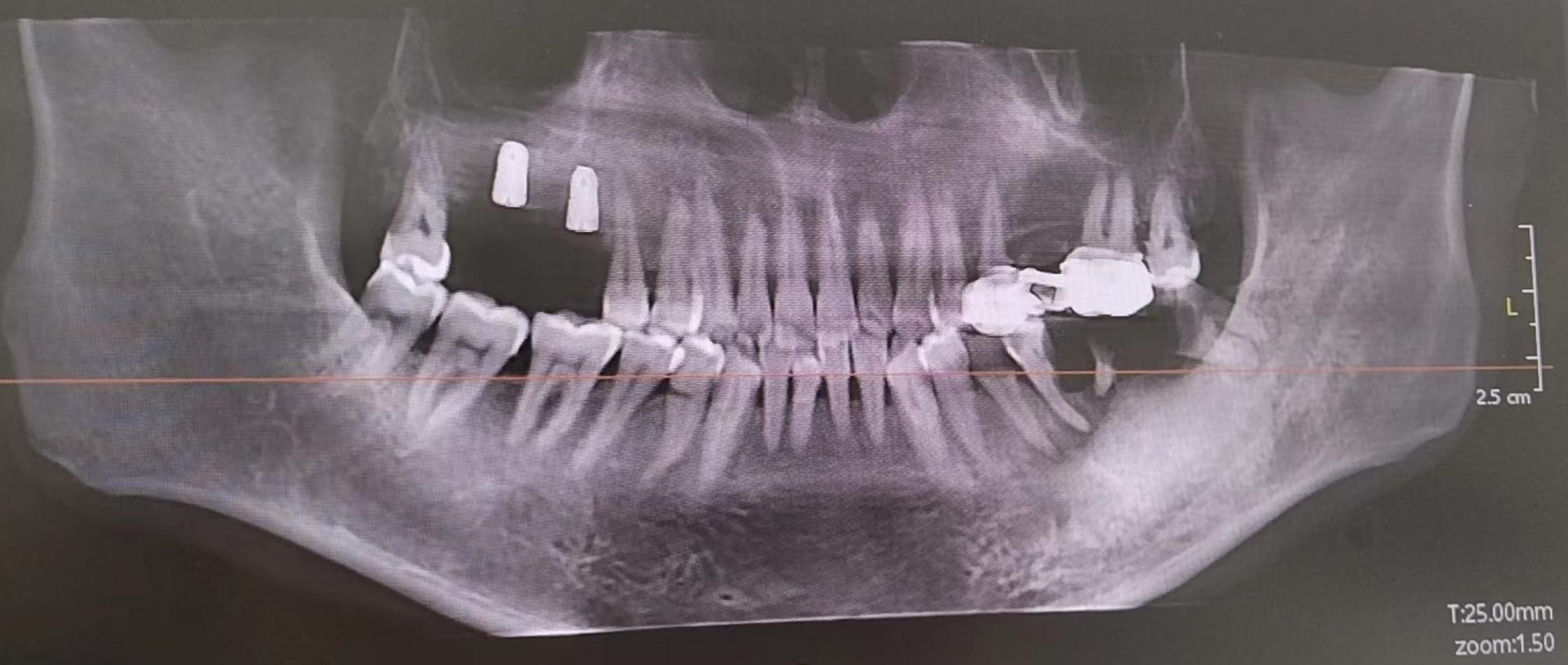 种植牙选择哪种牙好,种牙的材料如何选择