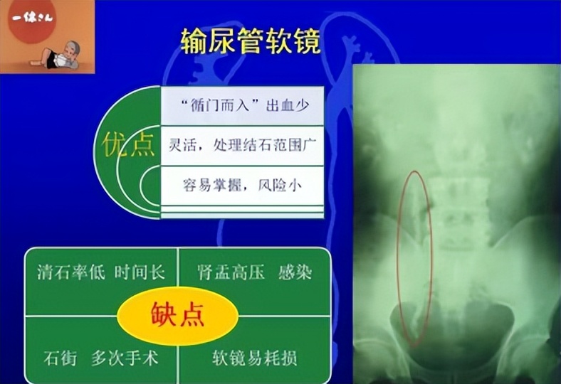 明知山有虎,偏向虎山行——肾斗士VS肾结石