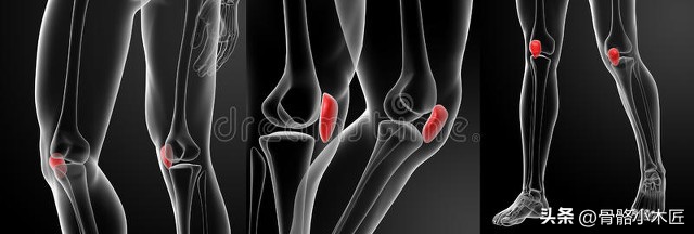 髌骨骨折二次手术取钢丝痛苦吗,髌骨骨折取钢钉手术完多久能走