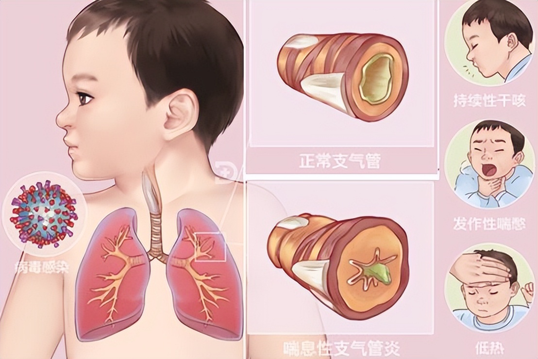 小儿喉气管炎治疗方法,中医小儿喉炎怎么治最快最有效