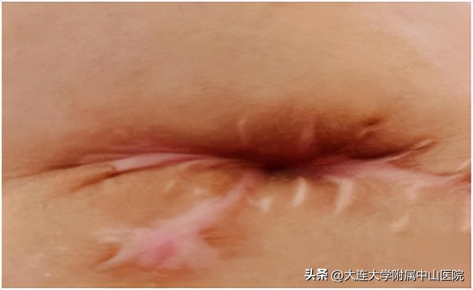 【案例回放】重症急性胰腺炎继发盲肠瘘危及生命，微创手术化险为夷