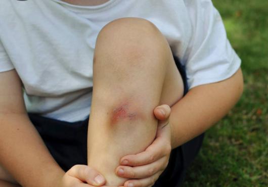 宝宝磕碰划伤怎么处理,孩子磕碰擦伤了怎么办