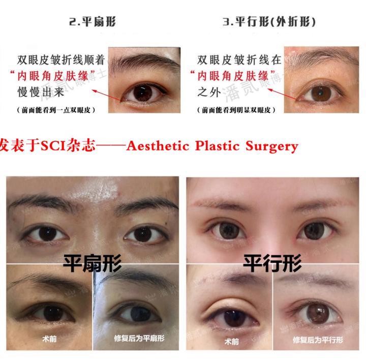 内眦赘皮用手术吗,内眼角内眦赘皮矫正不做手术