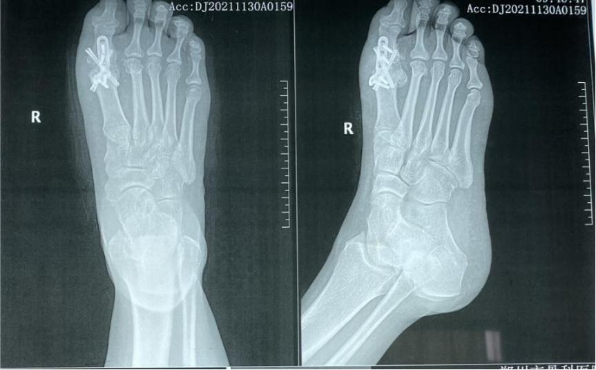 拇外翻术后——拇内翻治疗