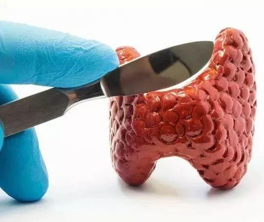 张景明甲状腺结节治疗方子,中医治疗甲状腺结节的中药方子