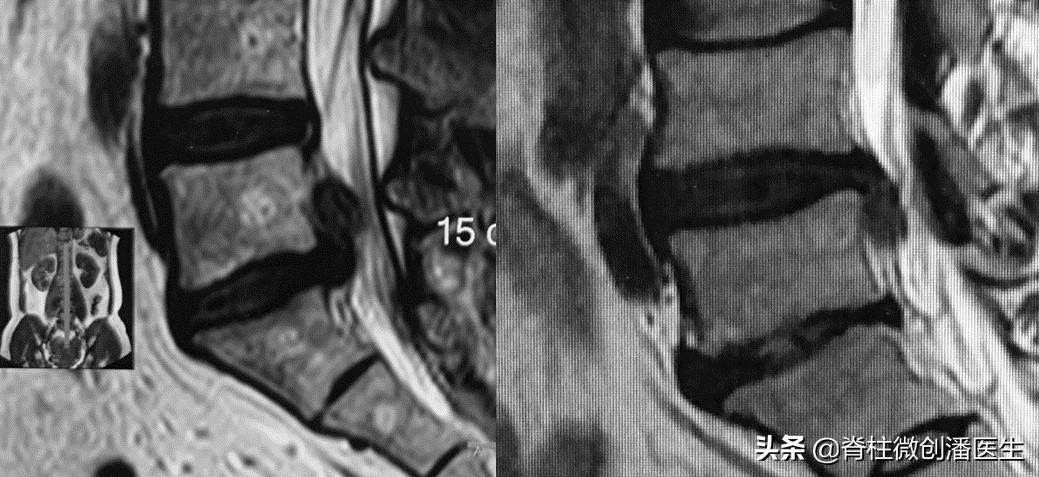 腰椎间盘4到5突出不手术会全好吗,70岁老人腰椎间盘突出适合手术吗