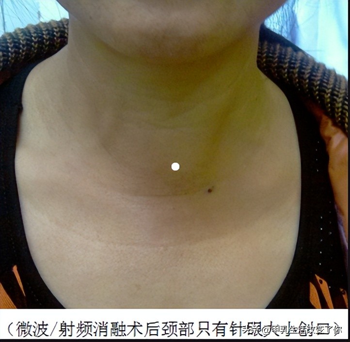 甲状腺结节微波消融最好的医院,临沂医院有甲状腺结节微波消融
