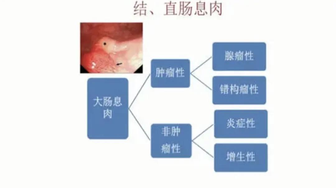 体检报告出现“息肉”，5种常见息肉哪些是良性，哪些会癌变？