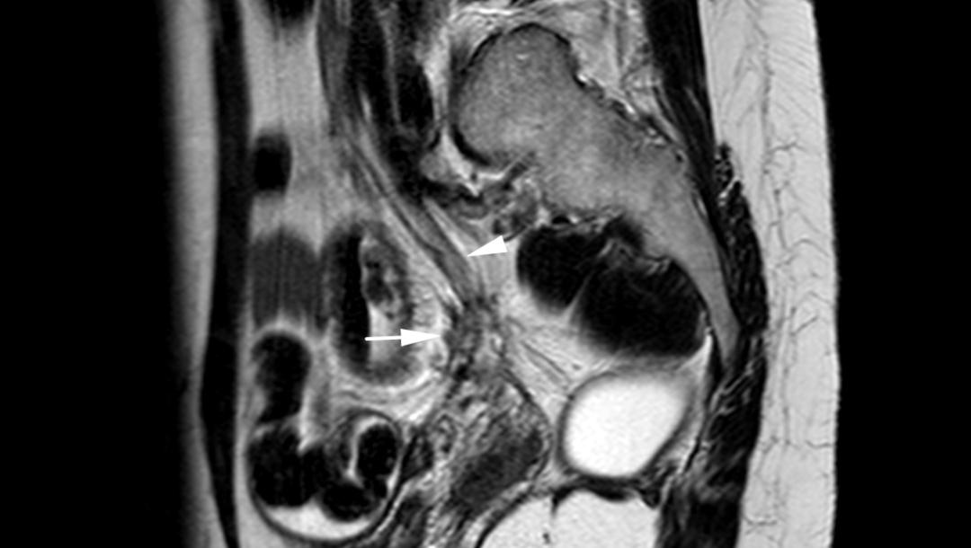 MRI如何评估子宫内膜异位症？这10个病例会帮助您