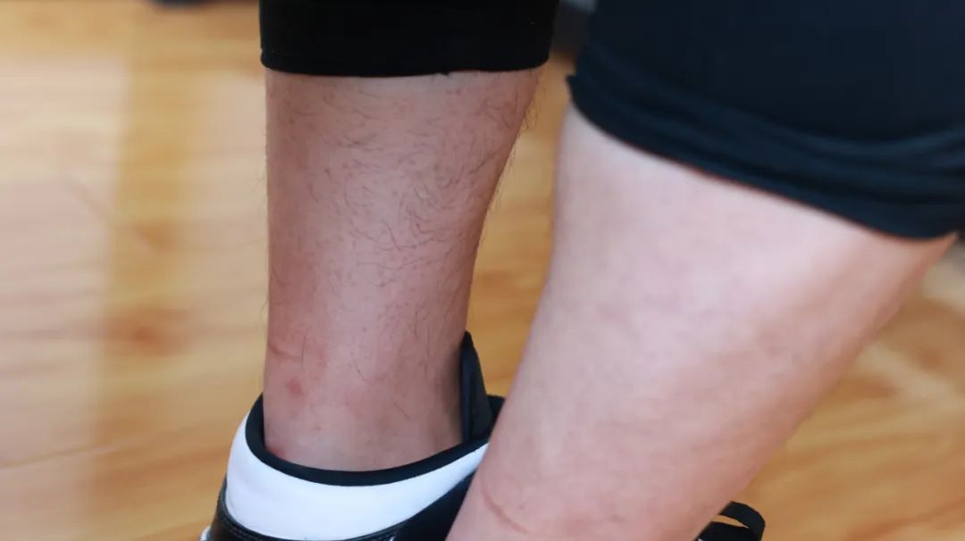 得了静脉曲张应该忌口吗,得了静脉曲张应注意些什么