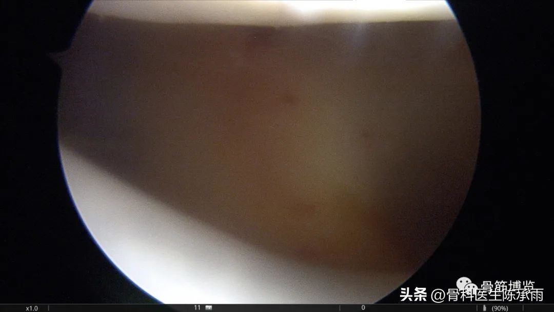 髌骨脱位软骨剥离怎么治疗,半月板撕裂游离体