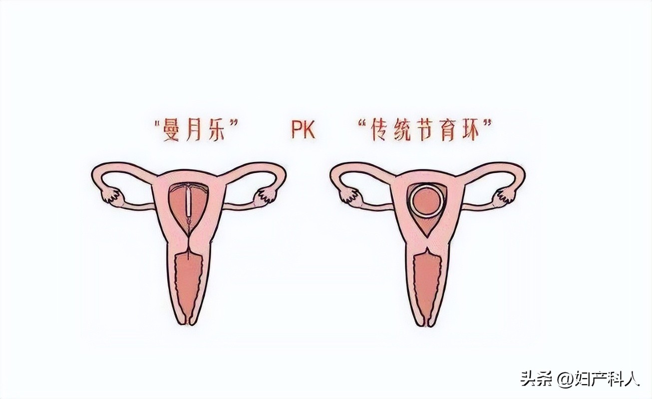 曼月乐又名什么,安了一年的曼月乐