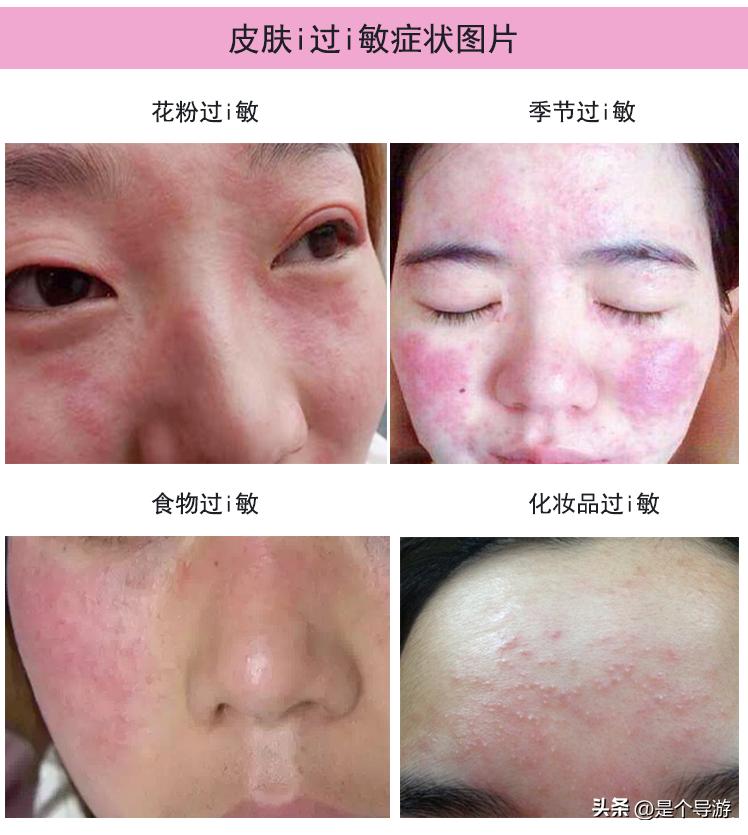 春季脸上干痒发红起小疙瘩怎么办,脸上皮肤泛红怎么修复春季