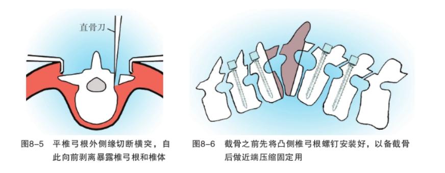 骨科基础：脊柱后侧凸截骨术