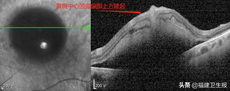 爱尔眼科专注摘镜手术,福州爱尔眼科医院技术