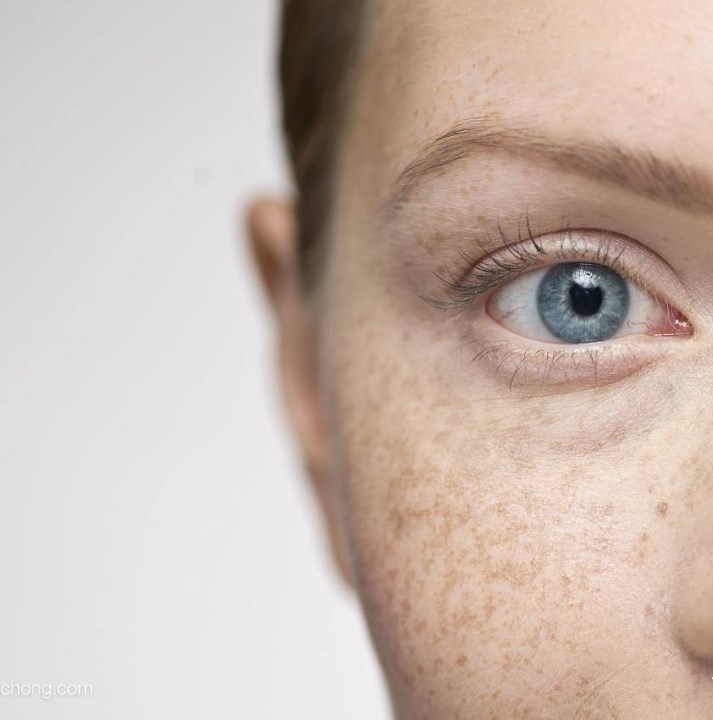 气滞血瘀黄褐斑可以吃血府逐瘀丸,气滞血瘀的斑喝哪些药材能淡化