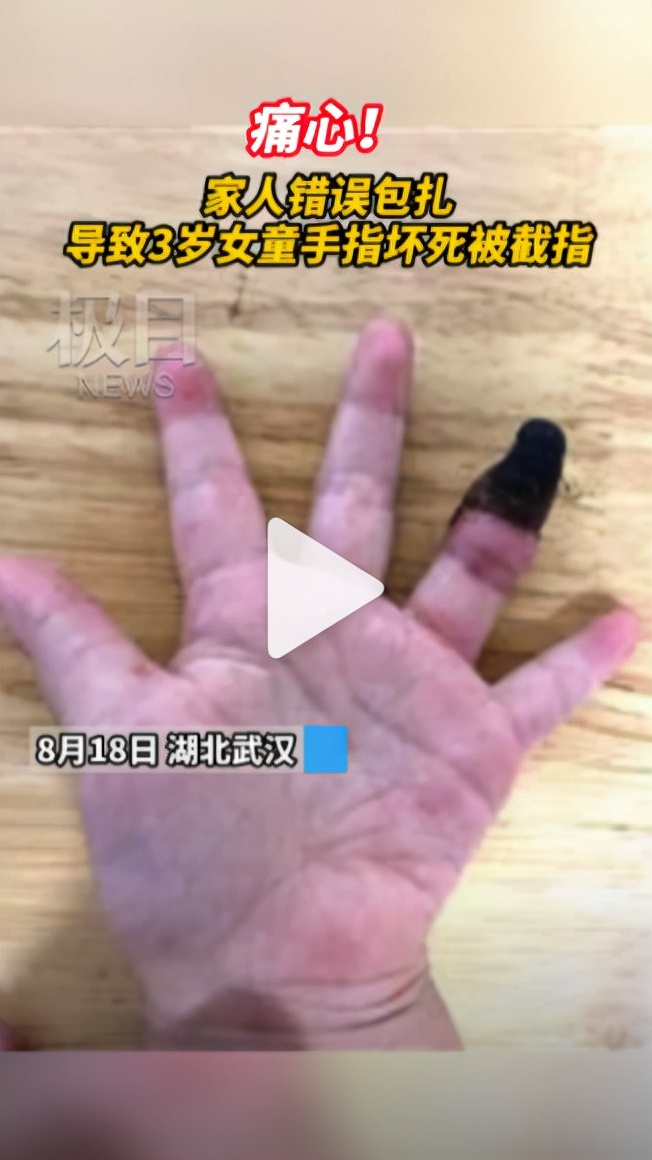 宝宝磕碰划伤怎么处理,孩子磕碰擦伤了怎么办