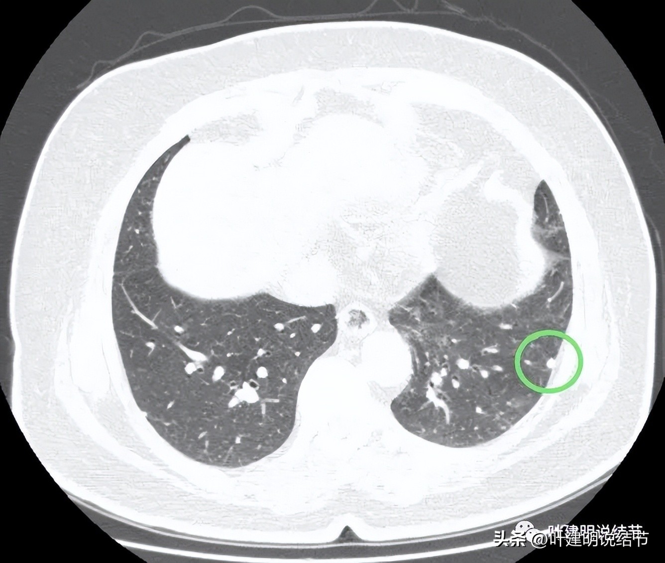 肺结节实性为什么建议抗炎治疗,肺上实性结节抗炎后变成空洞