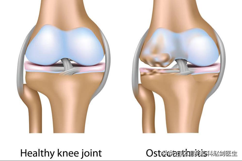 老年人膝关节磨损吃软骨素,膝关节骨质增生能吃氨糖软骨素吗