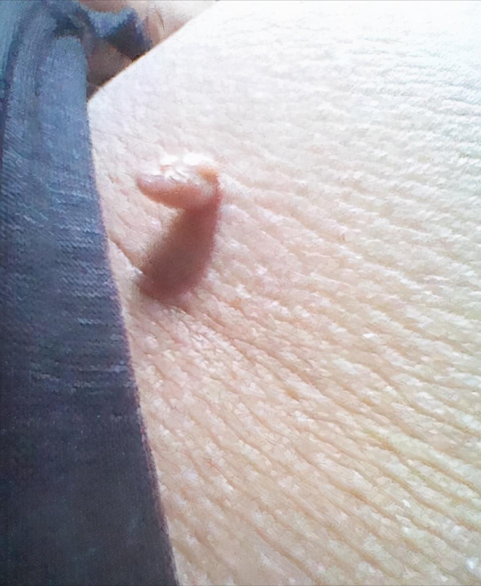 脖子上长小肉粒需要治疗吗,脖子上长了一个小肉粒有问题吗