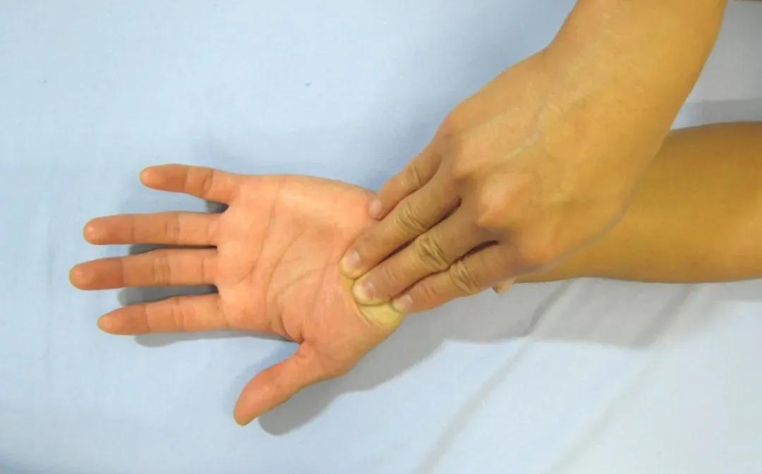 急性腕管综合征引起手腕痛怎么治,手腕管痛综合征治疗方法