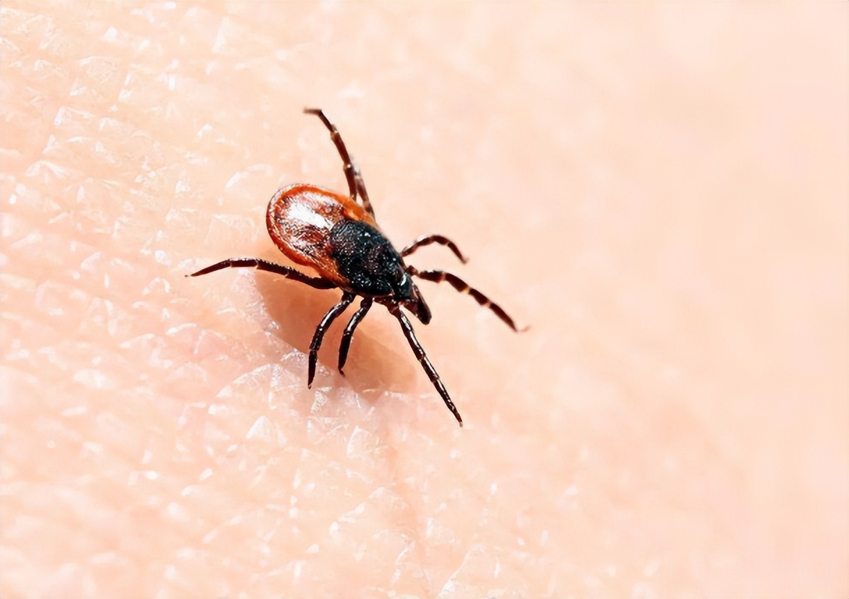 女子身上长虫医生拿镊子治疗,女子体内有蜱虫被医生拿镊子拔出