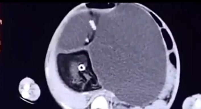 女童肚子超大疑似怀孕,2岁女婴肚中发现“胎儿”