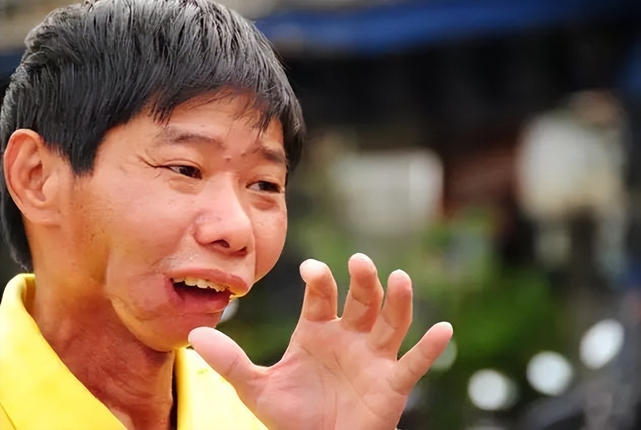 十年每天吃5包槟榔致毁容,28岁小伙持续吃五六包槟榔