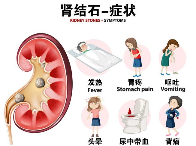 尿路结石应该要做哪些检查,尿路结石该做什么检查最准确