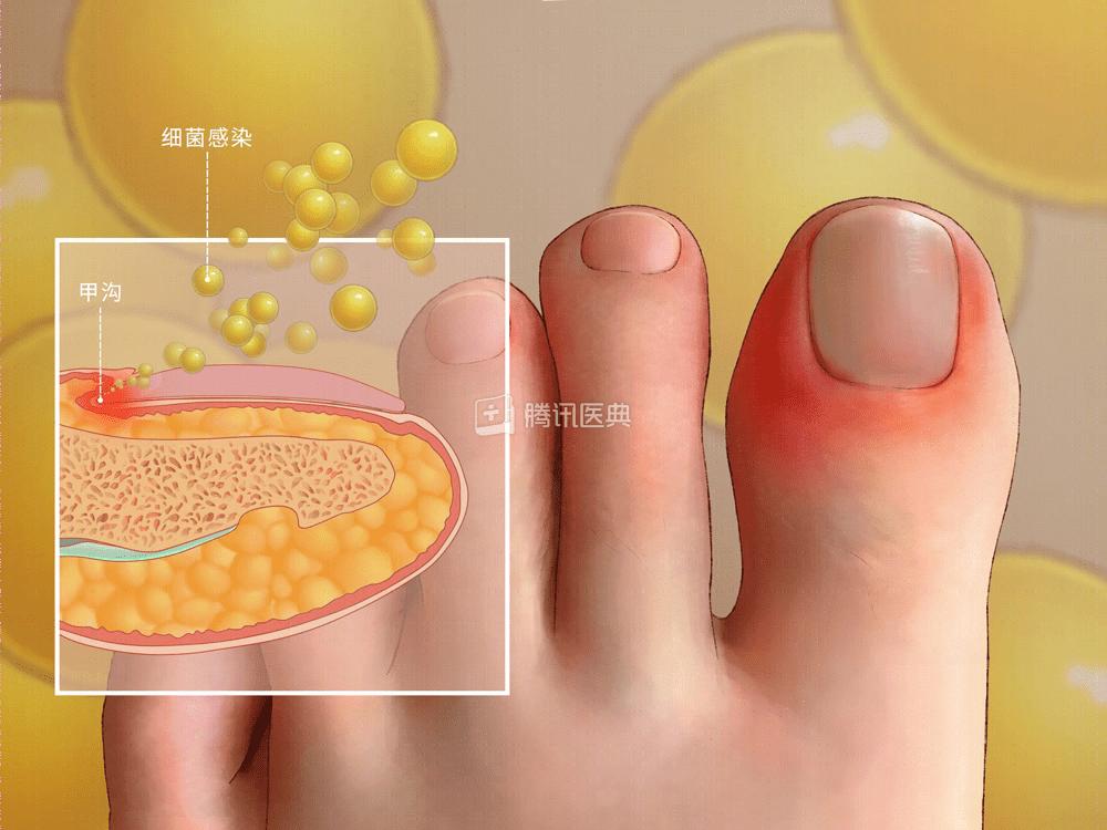 指甲长进肉里,手指甲长进肉里怎么办