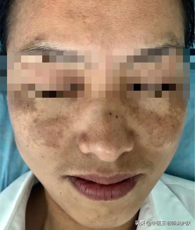 肝肾阴虚长斑怎么去掉,女人肝肾虚长斑怎么治