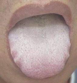 鼻充血鼻塞如何根治,鼻塞不通气鼻甲肥大用什么药物