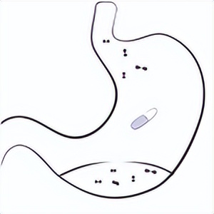 雌二醇用了会有什么副作用,雌二醇用量极限