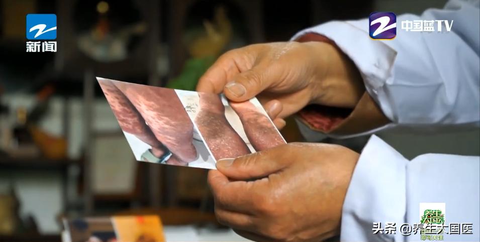 这种皮肤病用什么方法治疗好,顽固皮肤病的中医诊治思路