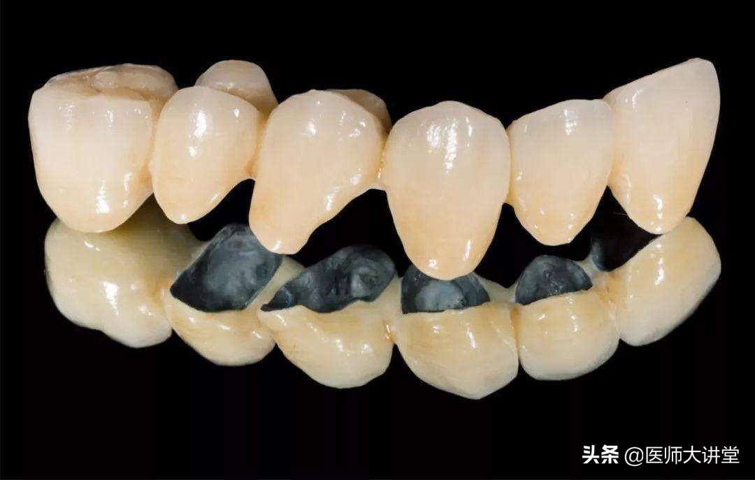 牙科医院做一个假牙大概多少钱,做假牙最便宜的多少钱一颗