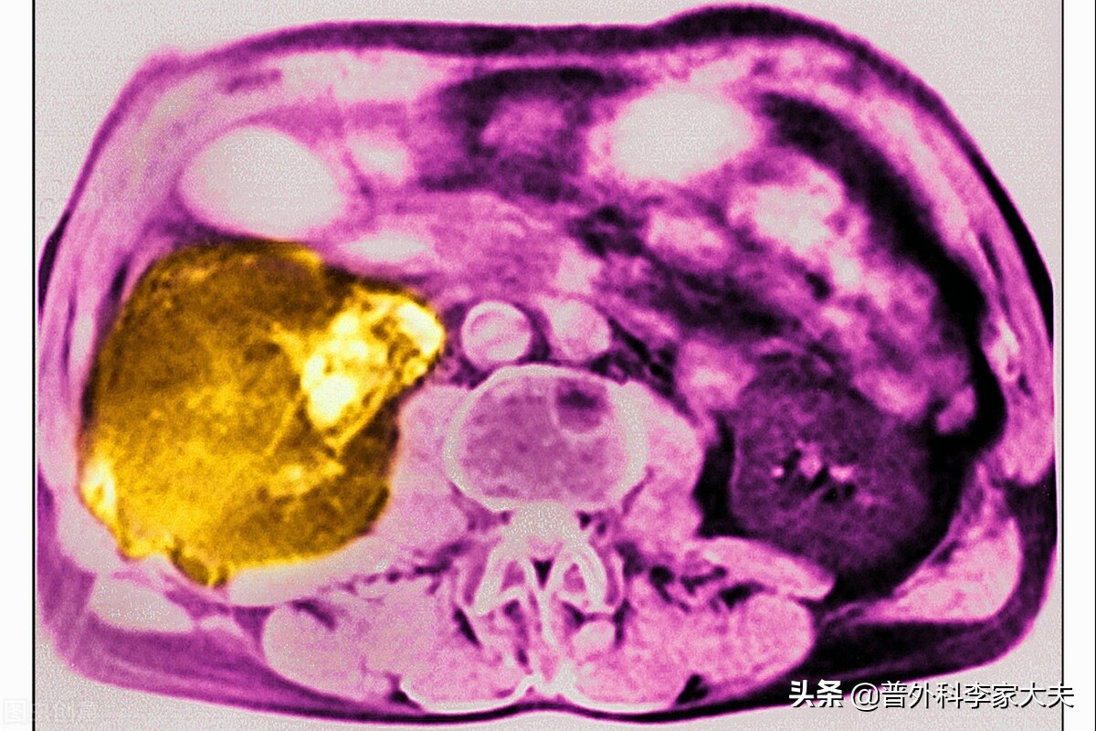 肝癌复发的原因,肝癌复发有哪些症状