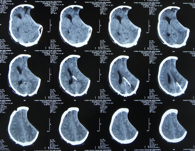 脑外伤开颅手术后继发癫痫,开颅术后颅内感染
