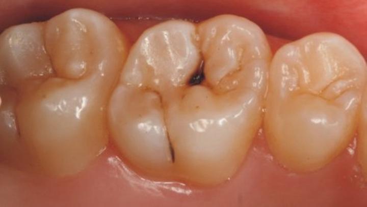 牙痛感觉牙齿如风一样什么情况,平时牙不疼但一嚼东西就疼