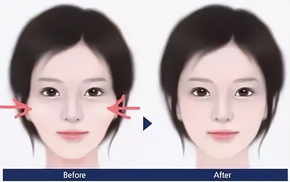 颧骨突出和颧骨外扩怎么改善,颧骨突出外扩适合戴什么眼镜