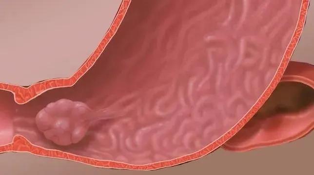 哪些息肉本来就会长的,容易癌变的息肉有哪些