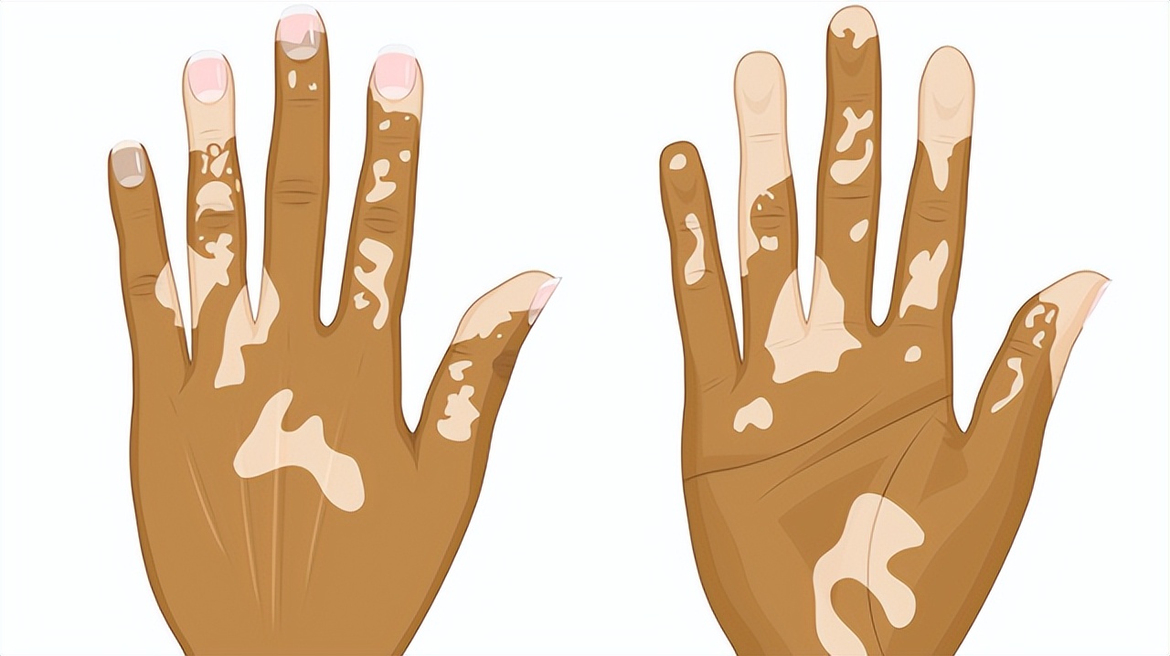 担心！身上出现白癜风该怎么办？这几点一定要注意