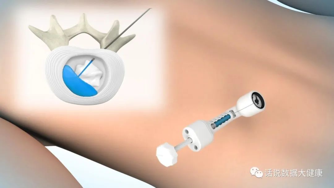 疼痛冷敷凝胶,疼痛冷敷凝胶的功效