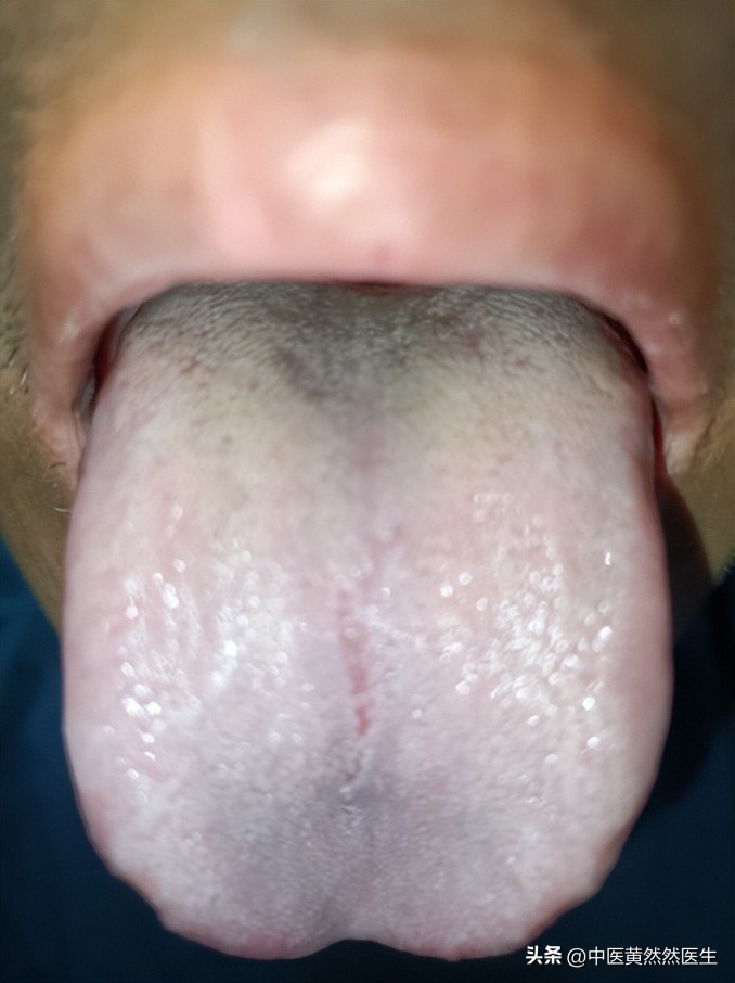 舌苔又白又黄中医辨证,舌苔又白又黄用什么药调理