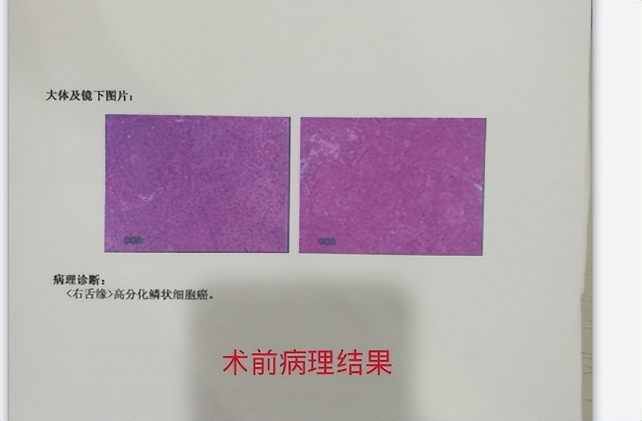 舌头一侧溃疡咽喉癌,舌头溃疡严重会是癌吗