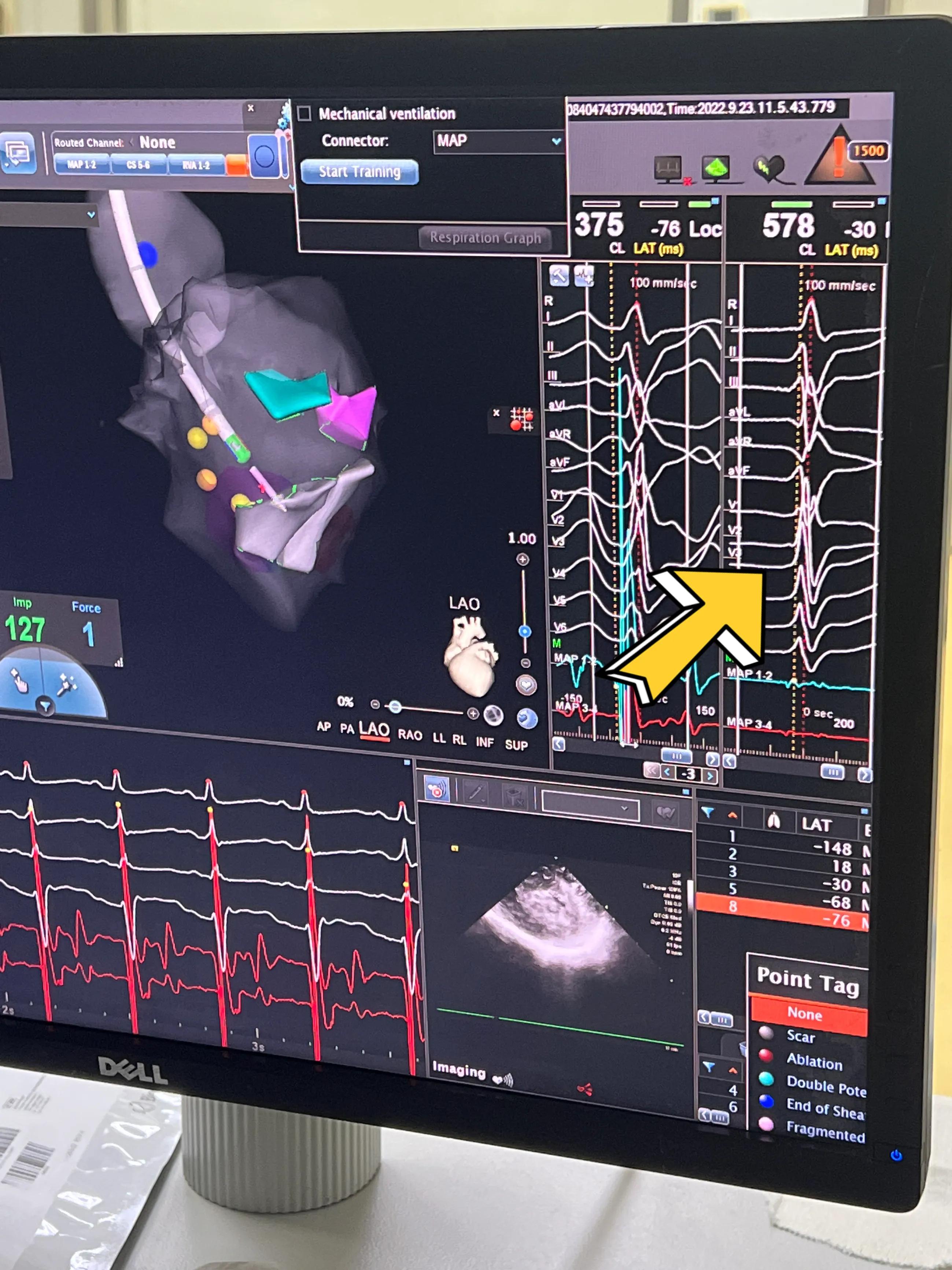 胸闷气促病例分析,小孩胸闷气短去检查说有炎症